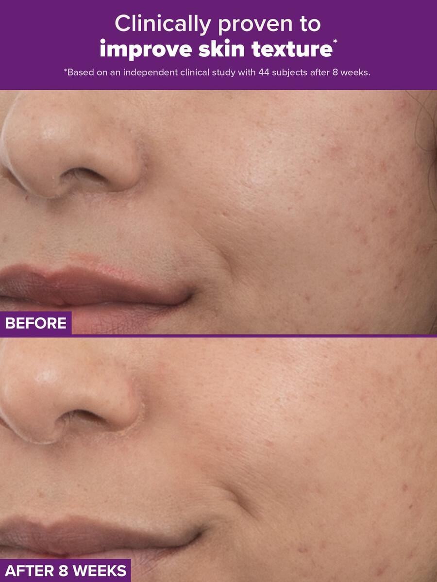 trattamento clinical pro retinaldeide a doppio retinoide