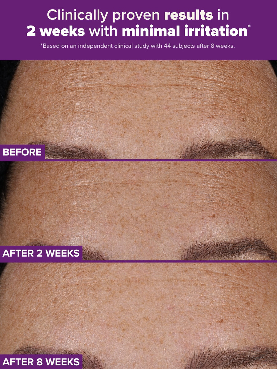 trattamento clinical pro retinaldeide a doppio retinoide
